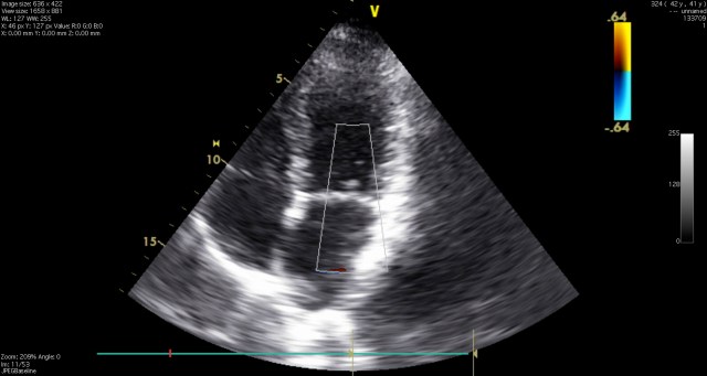 echocardiogram